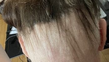 My Experience With Ophiasis Alopecia So Far