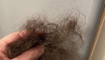 Alopecia Ophiasis: Hair Loss Again And It’s Worse This Time